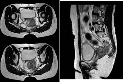 Image-guided interstitial brachytherapy for recurrent cervical cancer after radiotherapy: A single institution experience